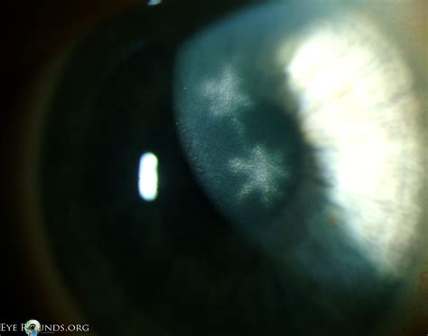 Atlas Entry - Ghost dendrites after resolution of herpes simplex virus (HSV) epithelial keratitis