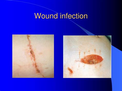 PPT - SURGICAL INFECTIONS PowerPoint Presentation, free download - ID ...