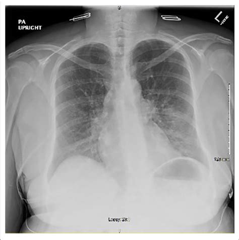 | Initial chest x-ray after onset of symptoms showing peribronchial m... | Download Scientific ...