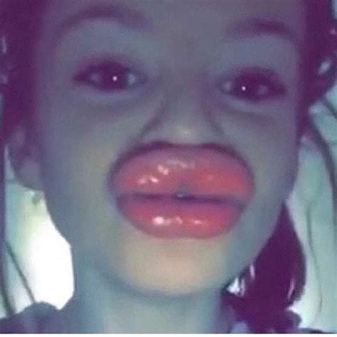 20 Reasons Why You Shouldn't Try The Kylie Jenner Lip Challenge