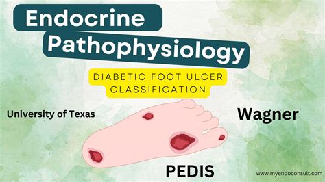 Diabetic Foot Ulcer Stages – A Concise Guide - My Endo Consult