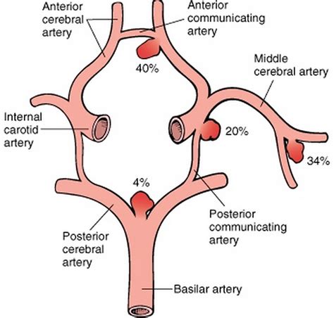 √ Aneurysm : Endovascular treatment of intracranial aneurysms - Because ...