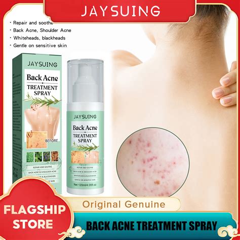 Jaysuing Back Acne Treatment Spray Removal Scar Pimple Acne Repair Oil ...