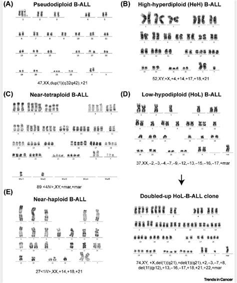 Aneuploid Karyotype Configurations Found in B-ALL. (A) G-banded... | Download Scientific Diagram