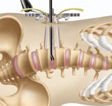 Extreme Lateral Interbody Fusion (XLIF) - Pomona, CA & Arcadia, CA: Inland Neurosurgery ...