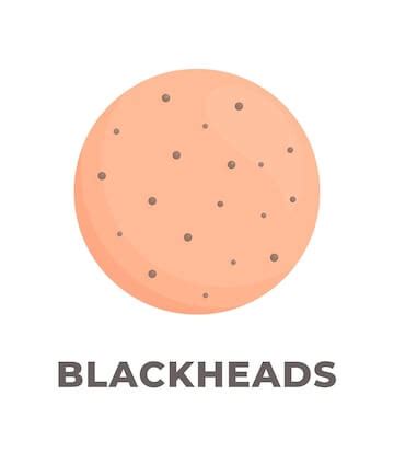 What are Blackheads? Causes & Prevention - St.Botanica