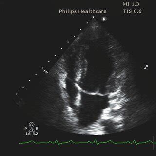 Echocardiography presented a preserved systolic and diastolic LV... | Download Scientific Diagram