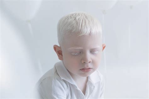 Albinismus Fotos | POPSUGAR Deutschland Stars Albino Human, Albino Model, Act For Kids ...
