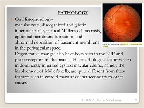 Cystoid macular oedema