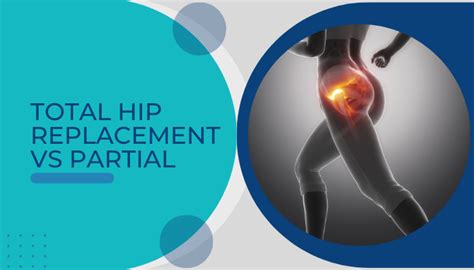 Total Hip Replacement Vs Partial - Dr Sartawi