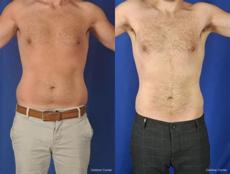 Liposuction Before And After Men