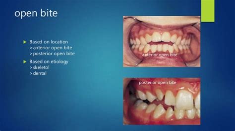 Anterior open bite aetiology and its management