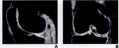 -MR images of articular cartilage of knee of 24-year-old healthy ...