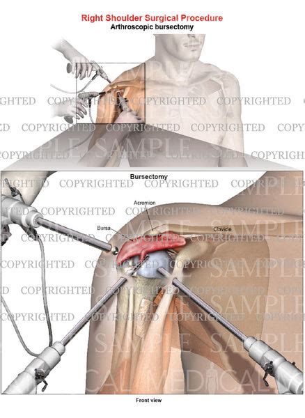 Right shoulder arthroscopic repair - Bursectomy - Male — Medical Art Works