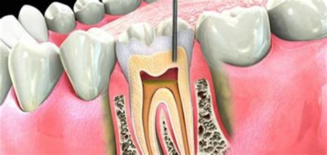 Treatment of dental nerve in the house