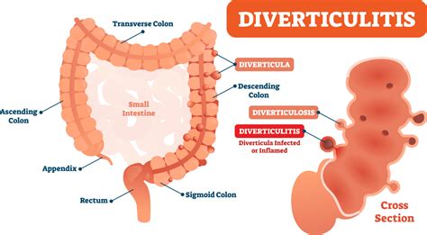 Diverting Diverticulitis - United Ostomy Associations of America