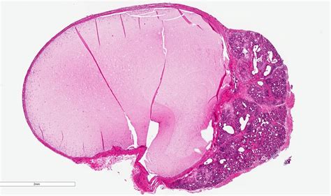 Ranula Histology