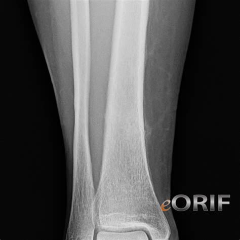 Tibial Shaft Stress Fracture M84.369A 733.93 | eORIF