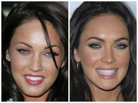 celebrity before and after veneers - Yahoo Image Search Results | Celebrity teeth, Celebrities ...