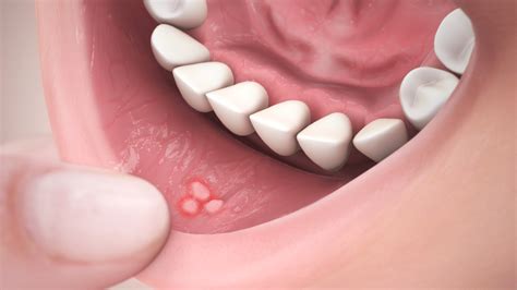 Canker Sores: Causes, Symptoms, Treatment and Medication