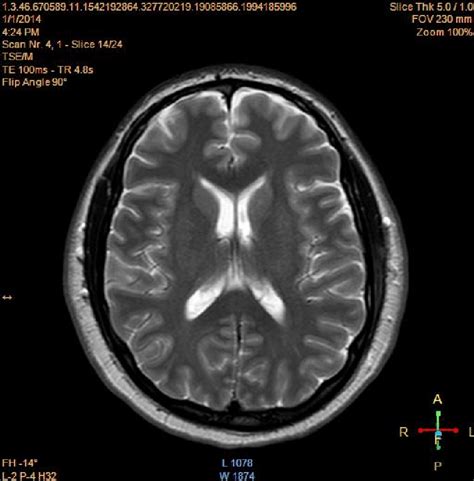 Basal Ganglia MRI