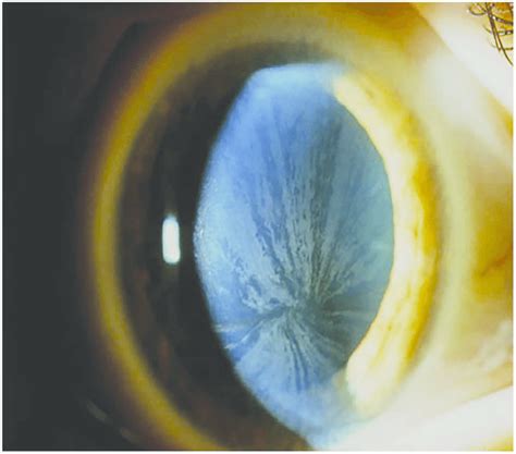 Cornea Verticillate - Ophthalmology Education blog - Ophthalmology ...