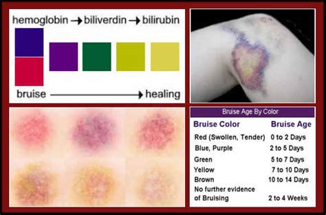 Bruises: The Secret Behind The Rainbow of Colors – Complete Wellness Report