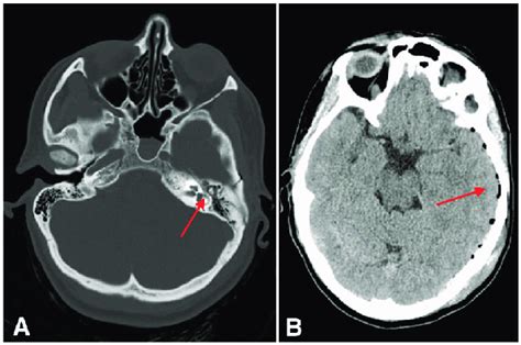 A CT scan showing left linear fracture of the petrous temporal bone B ...