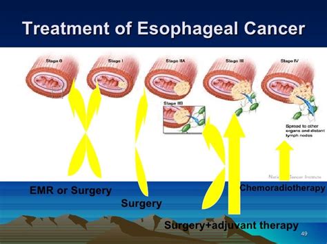 11 esophageal cancer