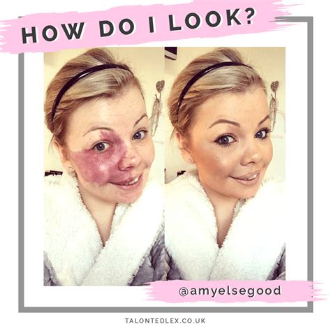 An interview with Amy about her Port Wine Stain birthmark. We chat skin ...