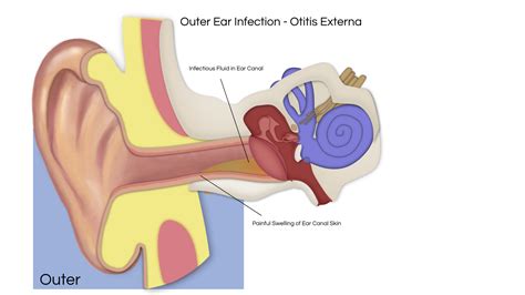 Ear Infection PNG, Otitis Externa (612.79 Kb) Free PNG | HDPng