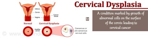 Cervical Dysplasia - Causes, Symptoms, Diagnosis, Treatment & Prevention