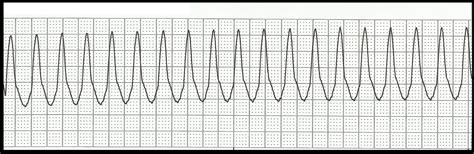 Float Nurse: Basic EKG Rhythm Test 06