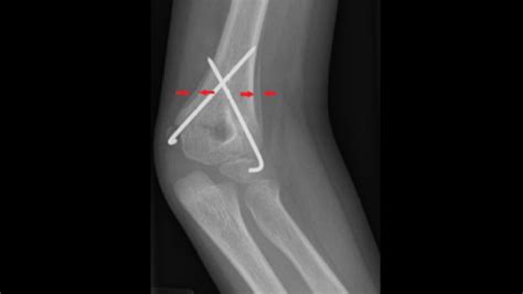 Supracondylar Fracture of Humerus: Physiotherapy management : Physiosunit