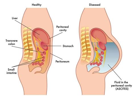 What is Ascites? | Ayurvedic treatment, Sunburn relief instant, Medical ...