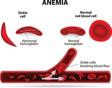 Sickle Cell Anemia - Nature's Way Medicine | Marijuana Treatment