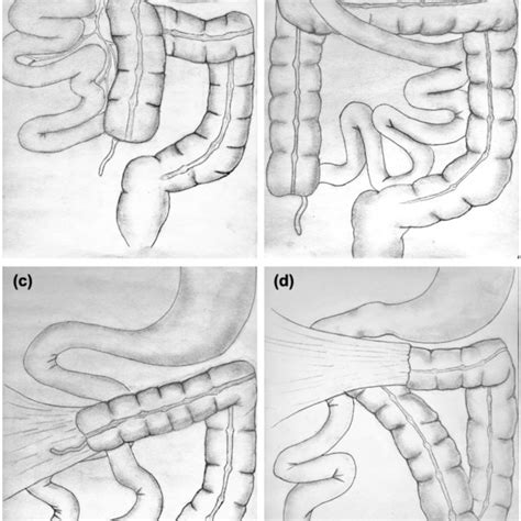 Schematic diagrams of the classification of intestinal malrotation and ...