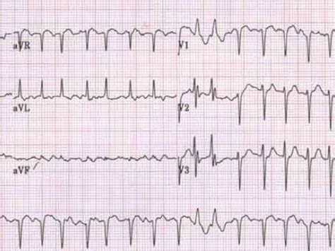 Permanent Afib Riskier Than Sporadic Arrhythmia | Medpage Today