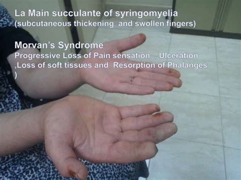 Syringomyelia ( Morvan syndrome) Electrodiagnosis | PPT