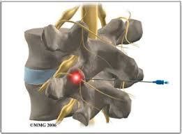 Facet Joint Denervation, Anatomy Models, शरीर के मॉडल in Jaipur , Gaurav Sharma | ID: 7132727030