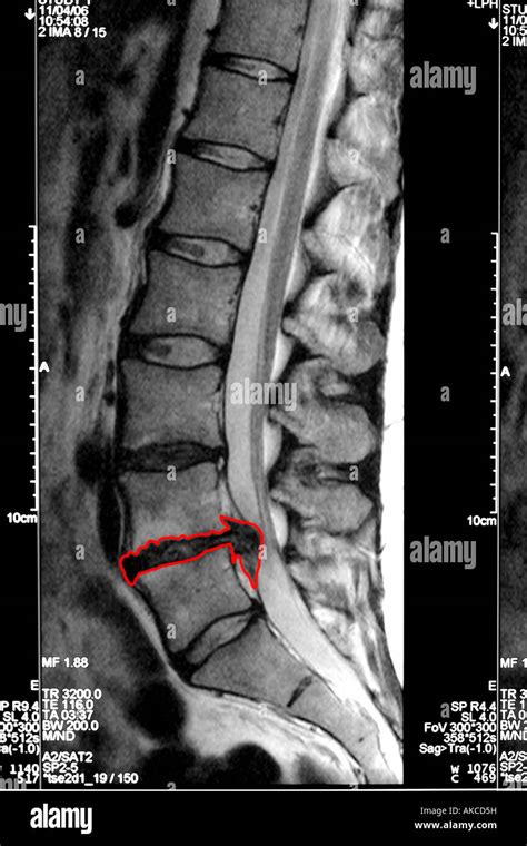 MRI scan clearly showing a slipped disc pressing on the spinal cord ...