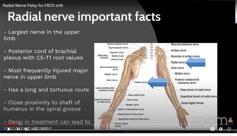 Radial Nerve Injuries for the FRCSOrth Exam — OrthopaedicPrinciples.com