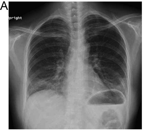 Interstitial pneumonia associated with neoadjuvant chemotherapy in breast cancer