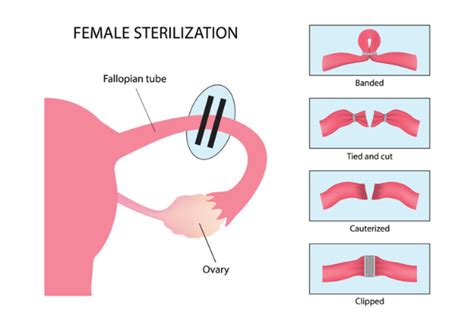 Tube Ligation reversal (Tubal anastomosis) - Pearl singapore