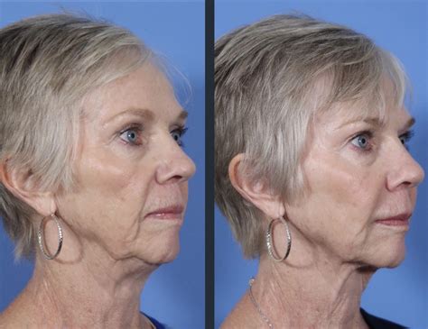 Liquid Facelift | Before & After Photos | Dr. Timothy Minton