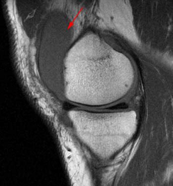 Lipoma Arborescens | Radsource