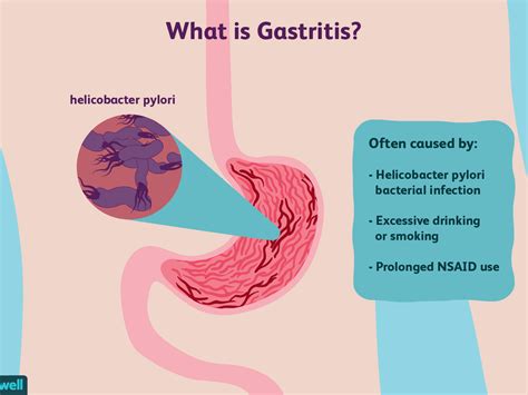 Can Acid Reflux Cause Ulcers On Tongue