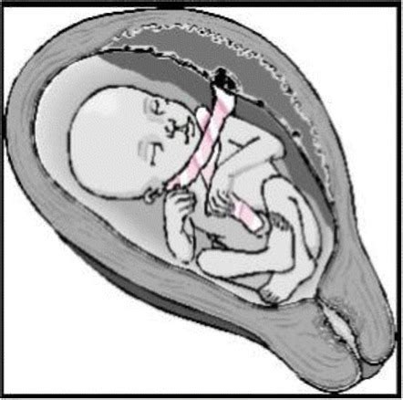 Nuchal cord types | Radiology Case | Radiopaedia.org