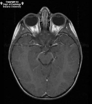 Neuroradiology On the Net: Tuber cinereum hamartoma