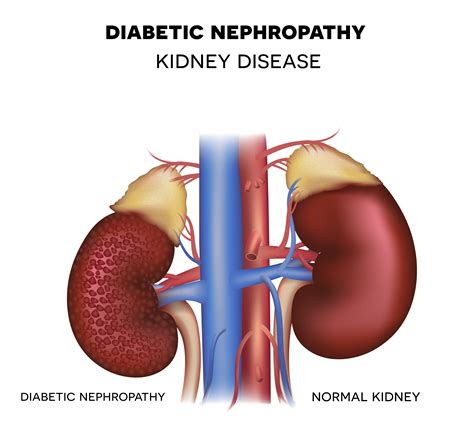 Renal Disease Diabetes - 1 : Tb kidney diabetes with renal ...